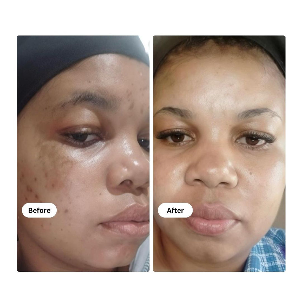 Before and after comparison of a person's face with visible skin improvement.